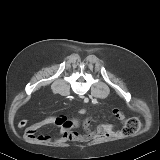 File:Bladder papillary urothelial carcinoma (Radiopaedia 48119-52951 Axial C+ delayed 35).png