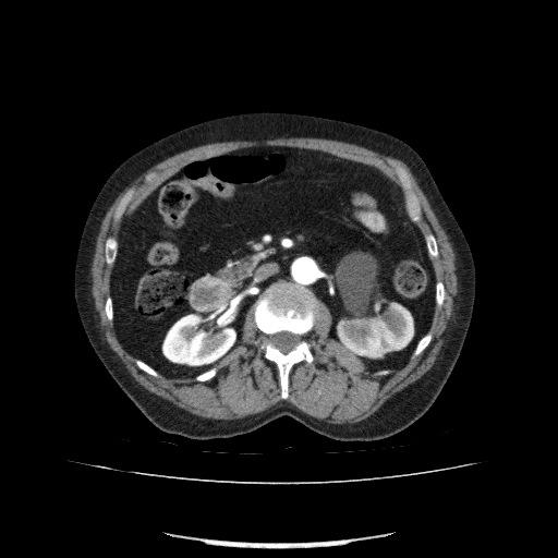 File:Bladder tumor detected on trauma CT (Radiopaedia 51809-57609 A 105).jpg