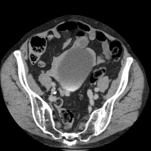 Bladder tumor detected on trauma CT (Radiopaedia 51809-57609 C 106).jpg