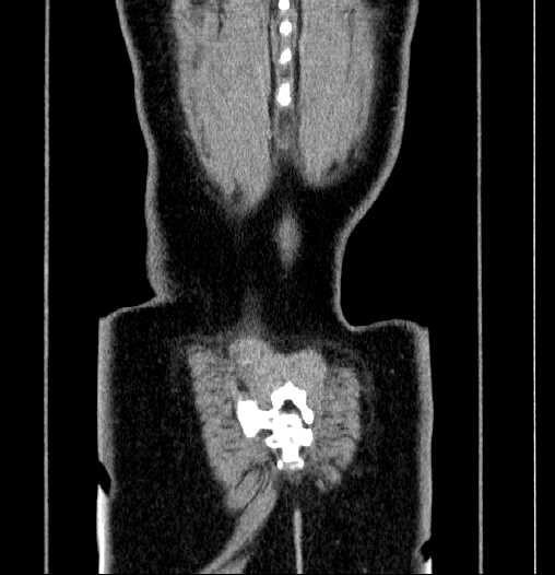 Blind-ending branch of a bifid ureter (Radiopaedia 61159-69048 F 68).jpg