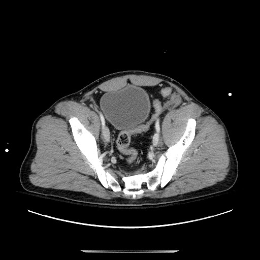 Blunt abdominal trauma with solid organ and musculoskelatal injury with active extravasation (Radiopaedia 68364-77895 A 130).jpg
