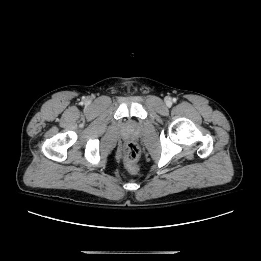 Blunt abdominal trauma with solid organ and musculoskelatal injury with active extravasation (Radiopaedia 68364-77895 A 156).jpg