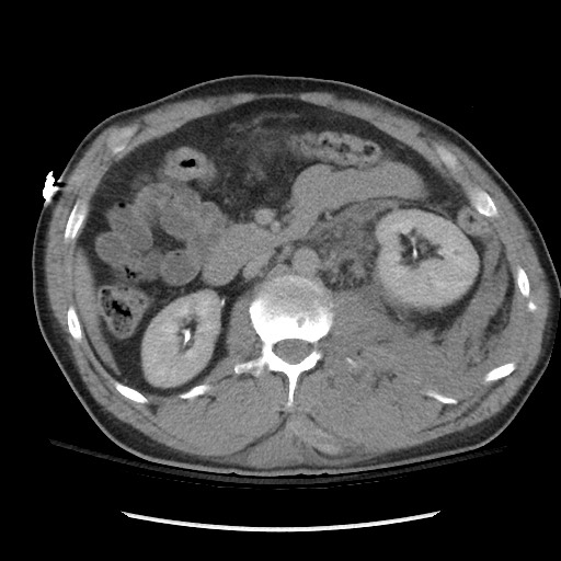 Blunt abdominal trauma with solid organ and musculoskelatal injury with active extravasation (Radiopaedia 68364-77895 Axial C+ delayed 58).jpg