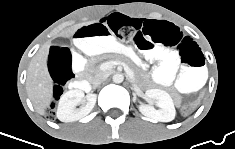 Blunt injury to the small bowel (Radiopaedia 74953-85987 A 48).jpg