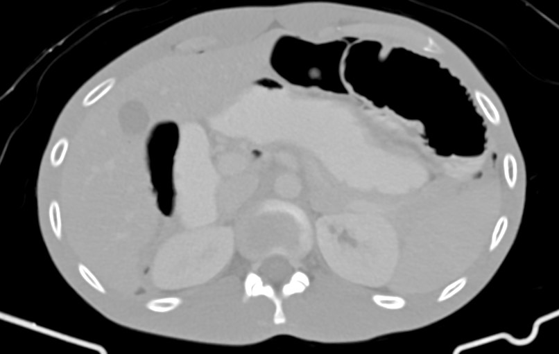 Blunt injury to the small bowel (Radiopaedia 74953-85987 Axial Wide 19).jpg