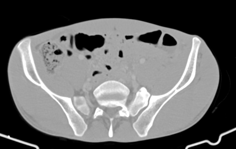Blunt injury to the small bowel (Radiopaedia 74953-85987 Axial Wide 72).jpg
