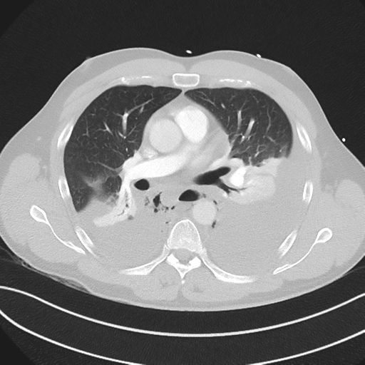 Boerhaave syndrome (Radiopaedia 39382-41660 Axial lung window 26).png