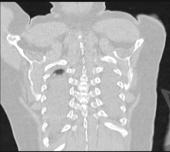 Boerhaave syndrome (Radiopaedia 45644-49799 Coronal lung window 62).jpg