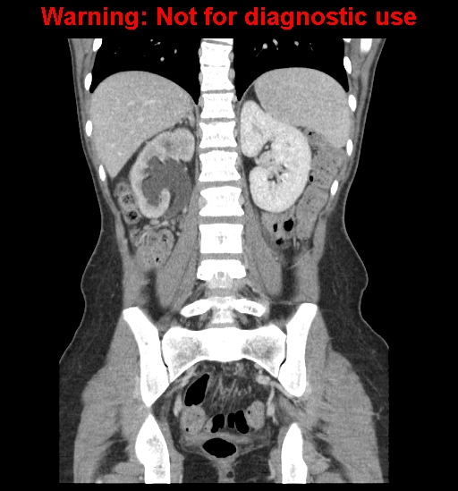 Borderline mucinous cystadenoma of ovary (Radiopaedia 25586-25767 B 46).jpg