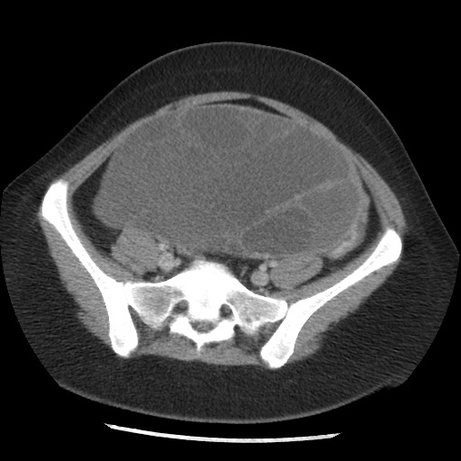 File:Borderline mucinous tumor (ovary) (Radiopaedia 78228-90808 A 113).jpg
