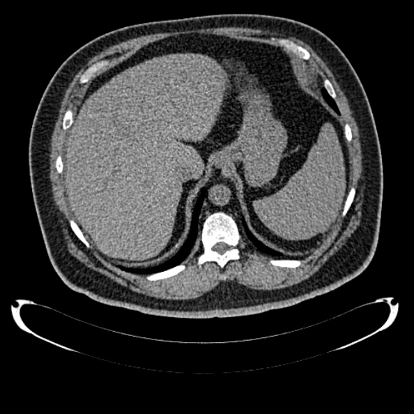 Bosniak renal cyst - type IV (Radiopaedia 24244-24518 Axial non-contrast 80).jpg