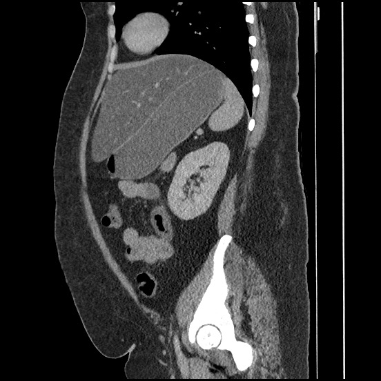 Bowel and splenic infarcts in acute lymphocytic leukemia (Radiopaedia 61055-68913 C 29).jpg