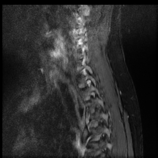 File:Brachial plexus neurofibroma (Radiopaedia 28030-28291 Sagittal STIR 2).png