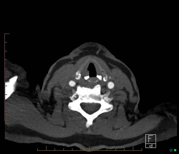 Brachiocephalic trunk stenosis (Radiopaedia 87242-103519 A 106).jpg