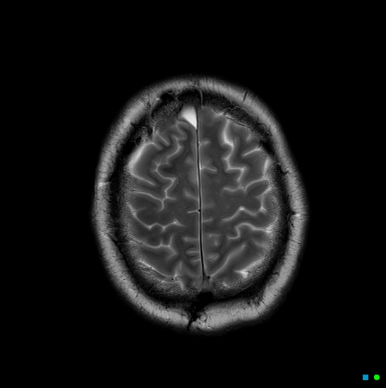 File:Brain death on MRI and CT angiography (Radiopaedia 42560-45689 Axial T2 27).jpg