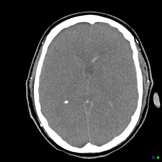 Brain death on MRI and CT angiography (Radiopaedia 42560-45841 B 26).jpg