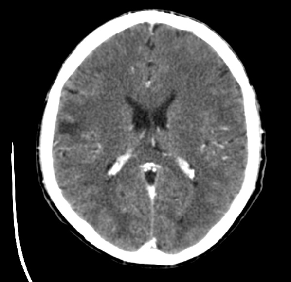 File:Brain metastases from lung cancer (Radiopaedia 24480-24781 Axial C+ delayed 35).jpg