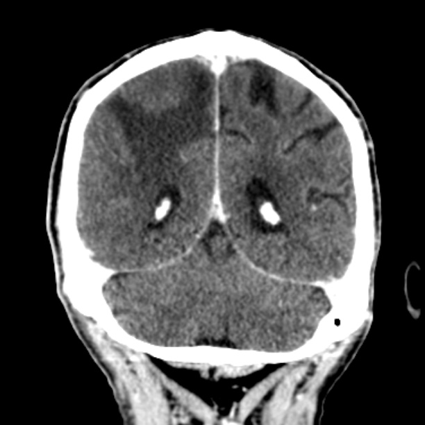 Brain metastases from lung cancer (Radiopaedia 27849-28092 Coronal C+ delayed 49).jpg