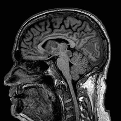 Brain metastases from lung cancer (Radiopaedia 83839-99028 Sagittal T1 61).jpg