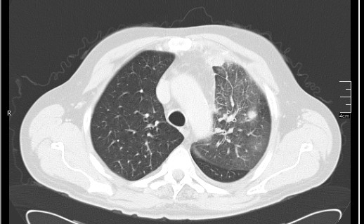 Brain metastases from squamocellular lung cancer (Radiopaedia 56515-63219 Axial lung window 22).jpg