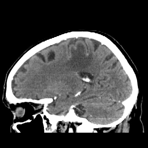 Brain metastasis (Radiopaedia 42617-45760 D 36).jpg