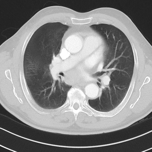Brain metastasis (large cystic mass) (Radiopaedia 47497-52104 Axial lung window 22).png