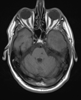 File:Brain metastasis (large cystic mass) (Radiopaedia 47497-52107 Axial T1 8).png