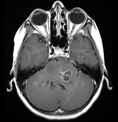 File:Brainstem glioma (Radiopaedia 9444-10124 Axial T1 C+ 1).jpg