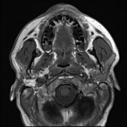 File:Branchial cleft cyst (Radiopaedia 31167-31876 Axial T1 23).jpg