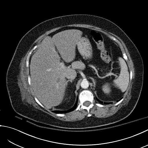 File:Breast carcinoma with pathological hip fracture (Radiopaedia 60314-67974 A 51).jpg