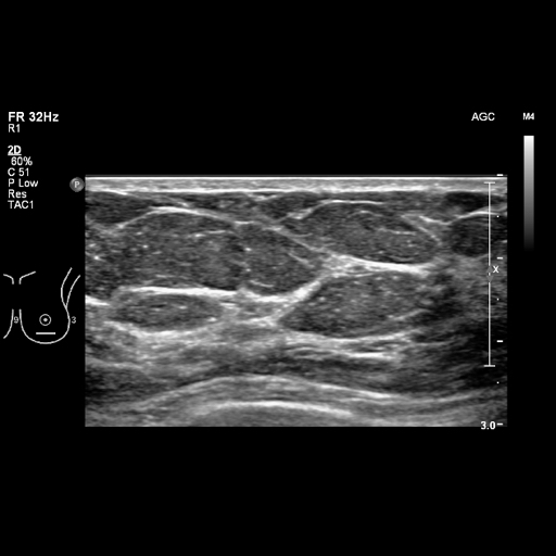 File:Breast metastases from renal cell cancer (Radiopaedia 79220-92226 Left breast US 23).jpeg