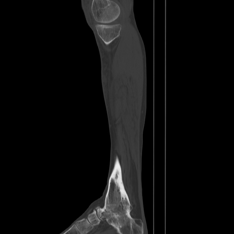 Brodie abscess - tibia (Radiopaedia 66028-75204 Sagittal bone window 9).jpg