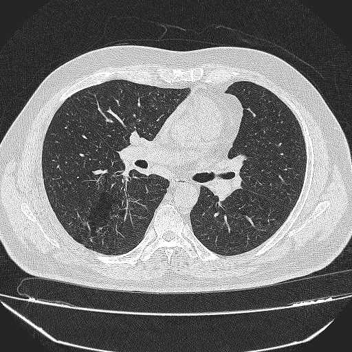 File:Bronchial atresia (Radiopaedia 58271-65417 Axial lung window 23).jpg