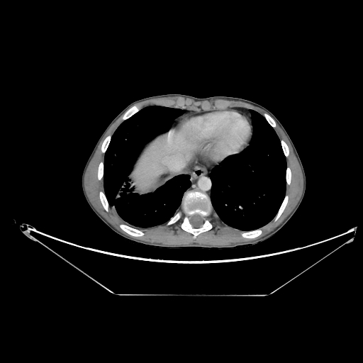 Bronchial carcinoid tumor (Radiopaedia 57187-64090 A 61).jpg