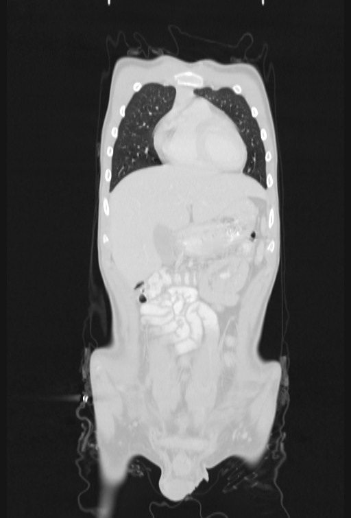 Bronchial carcinoid tumor (Radiopaedia 57187-64090 Coronal lung window 17).jpg