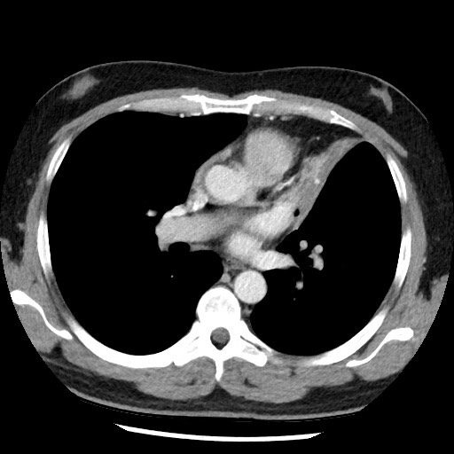 File:Bronchial carcinoid tumor (Radiopaedia 67377-76764 A 32).jpg