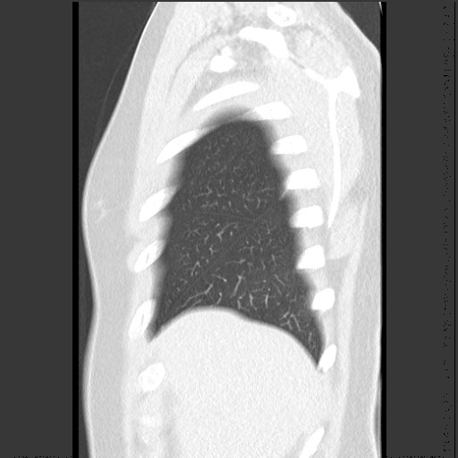 File:Bronchial carcinoid tumor (Radiopaedia 67377-76764 Sagittal lung window 10).jpg