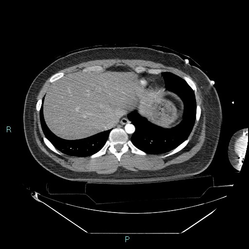 Bronchial carcinoid tumor (Radiopaedia 78272-90870 B 99).jpg