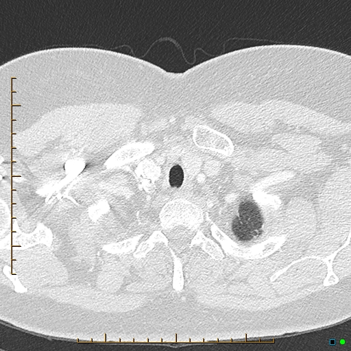 File:Bronchial diverticula (Radiopaedia 79512-92676 Axial lung window 2).jpg