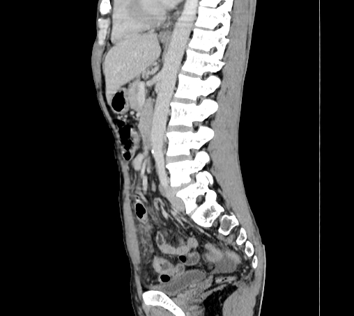 File:Bronchiectasis in Crohn disease (Radiopaedia 60311-67977 D 64).jpg