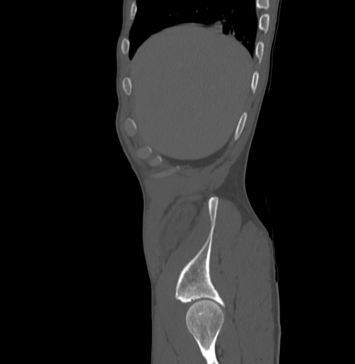 File:Bronchiectasis in Crohn disease (Radiopaedia 60311-67977 Sagittal bone window 1).jpg