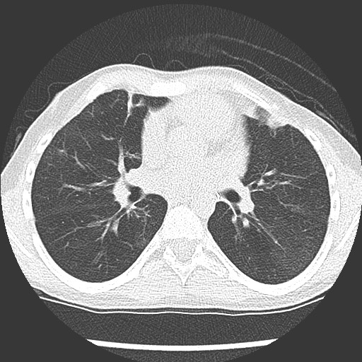 Bronchiolotis obliterans (Radiopaedia 73769-84575 Axial lung window 24).jpg