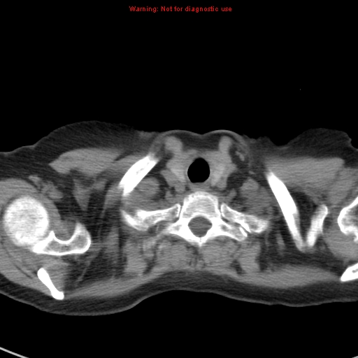 File:Bronchoalveolar carcinoma (BAC) (Radiopaedia 13436-13392 Axial non-contrast 2).jpg