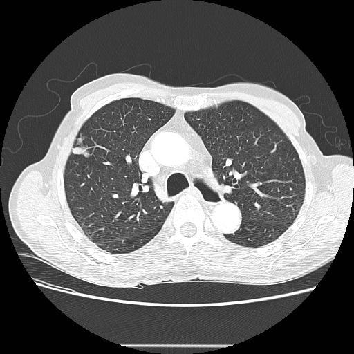 Bronchocele (Radiopaedia 17097-16795 Axial lung window 43).jpg