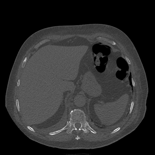 Bronchogenic carcinoma with metastatic lymphadenopathy (Radiopaedia 37671-39569 Axial bone window 50).jpg