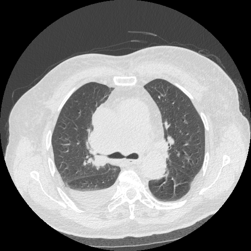 Bronchogenic carcinoma with metastatic lymphadenopathy (Radiopaedia 37671-39569 Axial lung window 22).jpg