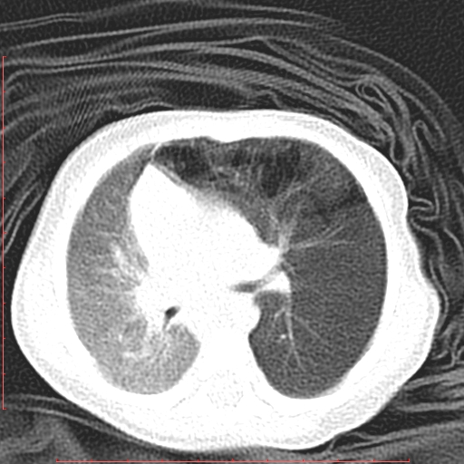 Bronchogenic cyst (Radiopaedia 78599-91409 Axial lung window 65).jpg