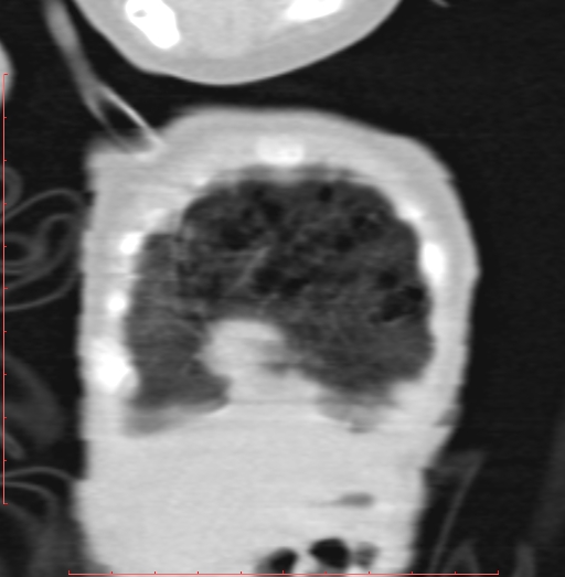 Bronchogenic cyst (Radiopaedia 78599-91409 Coronal lung window 27).jpg