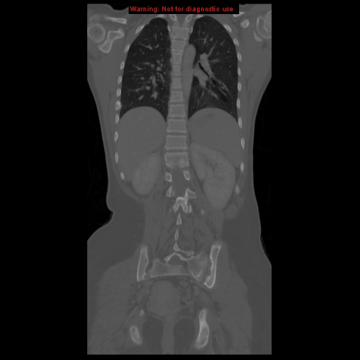 File:Brown tumor (Radiopaedia 12318-12596 D 46).jpg