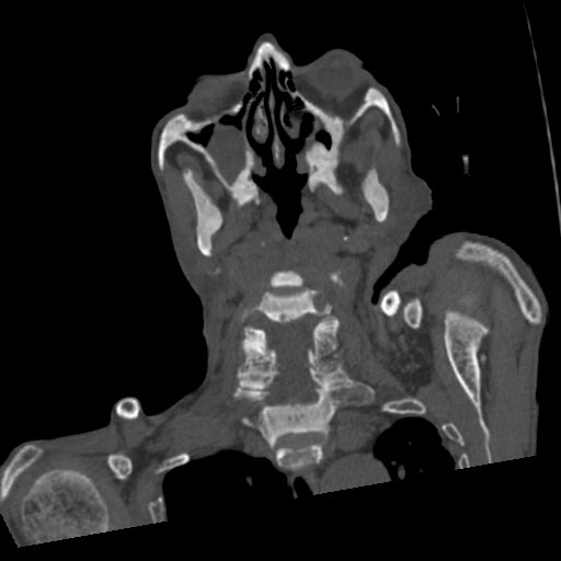 File:Brown tumor with secondary hyperparathyroidism (Radiopaedia 23591-23705 C 32).jpg